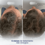 Tratamento do Couro Cabeludo