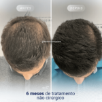 Tratamentos Domiciliares para Queda de Cabelo e Calvície